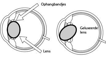 lensluxatie