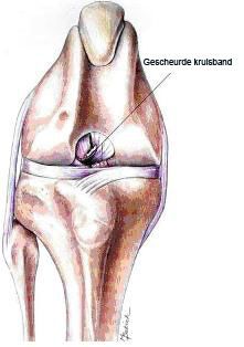 gescheurde-kruisband.jpg