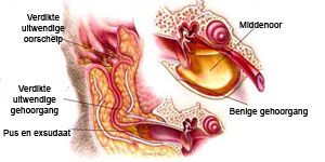 otitis-externa.jpg